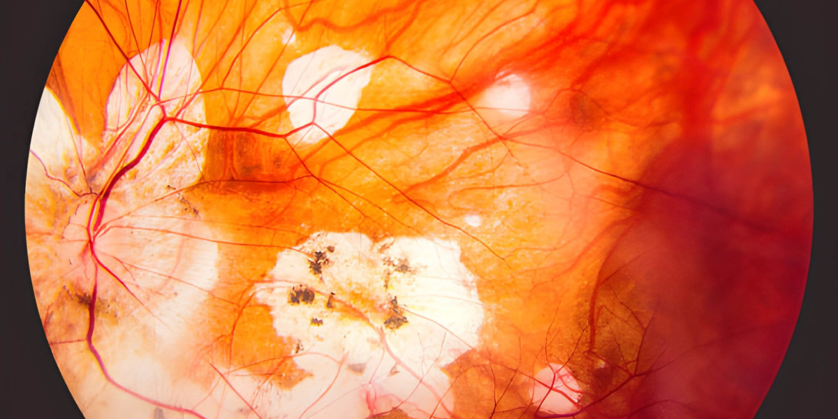 Polypoidal Choroidal Vasculopathy: Advances in Diagnosis, Treatment, and Market Outlook