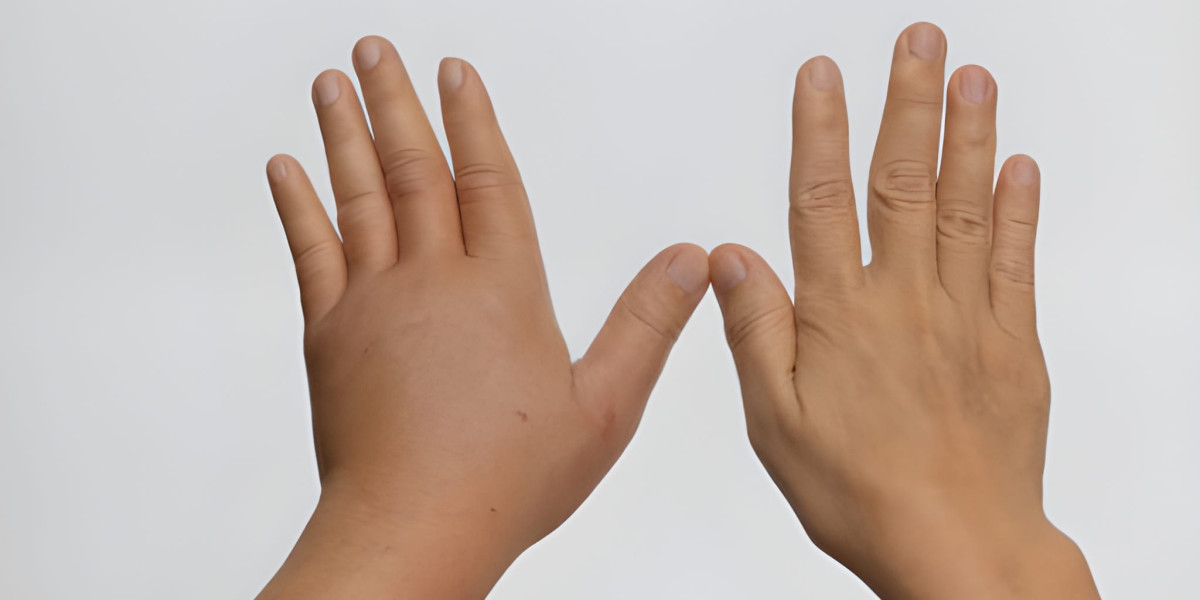 Acrocallosal Syndrome: Genetic Insights, Clinical Features, and Advancing Care